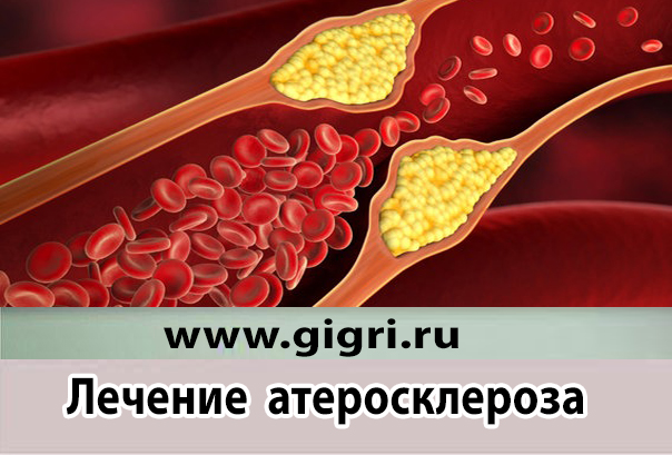 lechenie ateroskleroza v germanii gigri ru