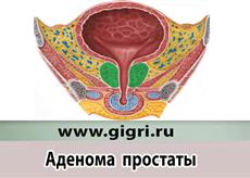 adenoma prostaty dgpzh