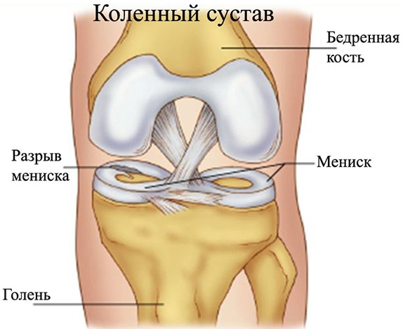 menisk kolennogo sustava