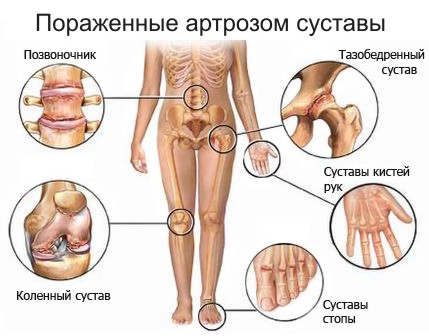 porazhennye artrozom chelovecheskie sustavy