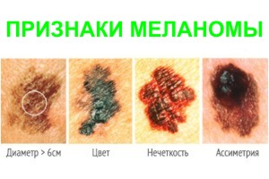 priznaki melanomy